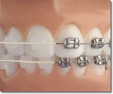 How Much Are Braces | drdentalimplants.com